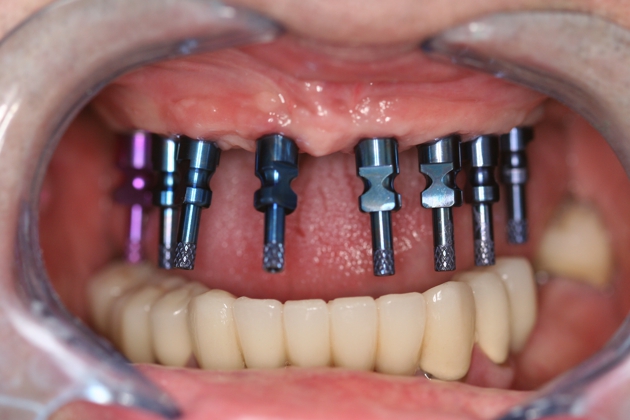 Ottawa Dental Implants